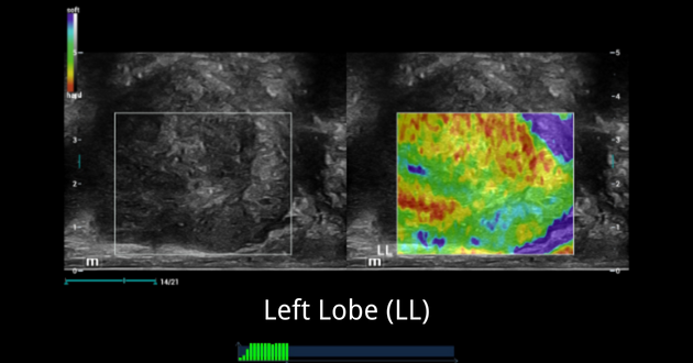 prostate-shearwave-fig5-pc