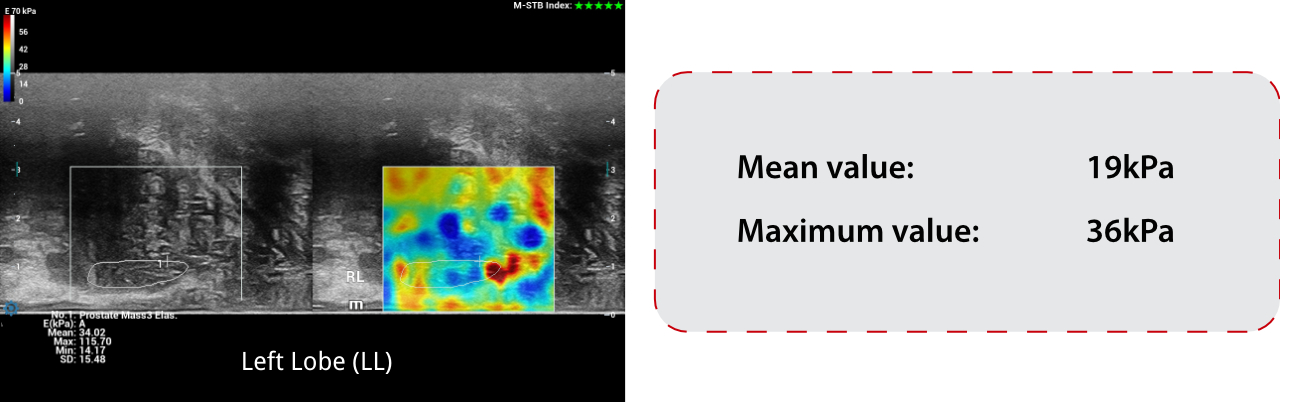 prostate-shearwave-fig7-pc