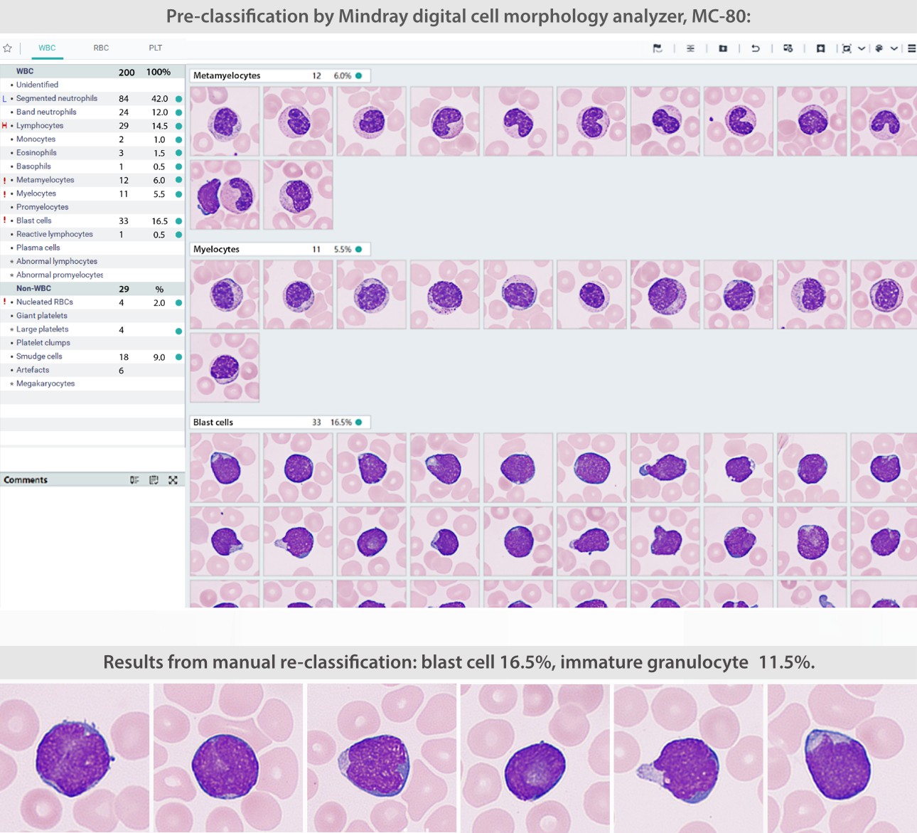 A Case Study of Acute Lymphocytic Leukemia (ALL)