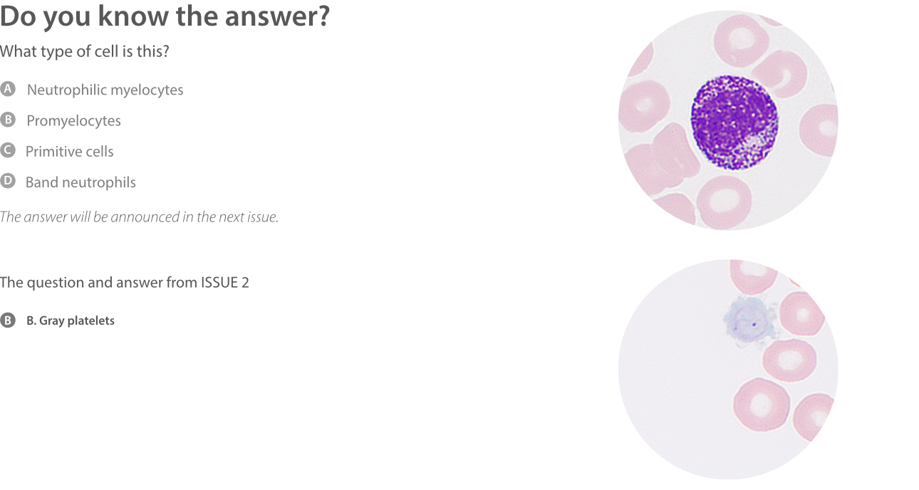 A Case Study of Acute Lymphocytic Leukemia (ALL)