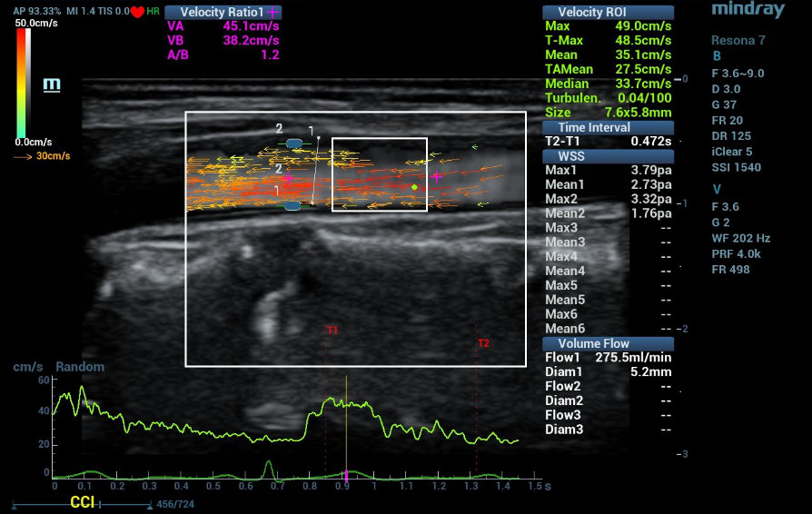 carotid-atherosclerotic-kv-pc