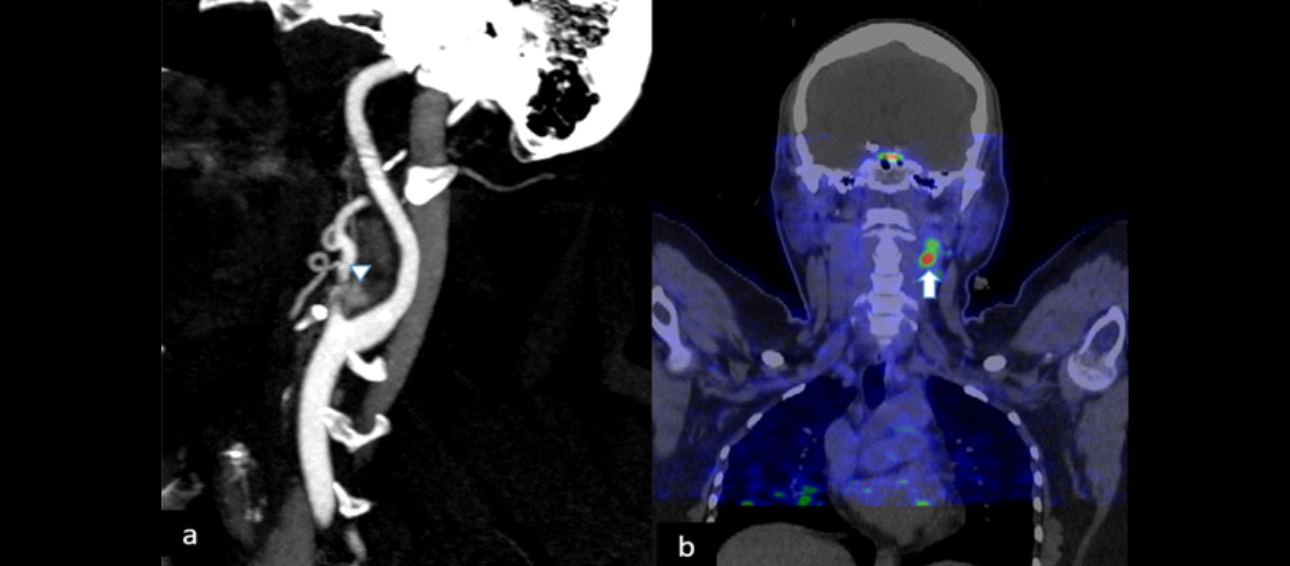 carotid-glomus-fig5-pc