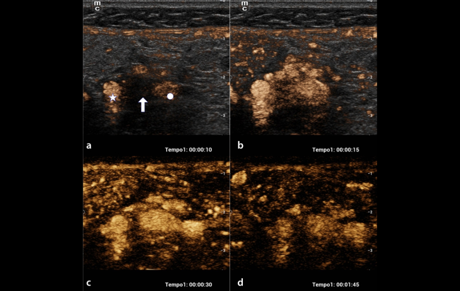 carotid-glomus-kv-pc