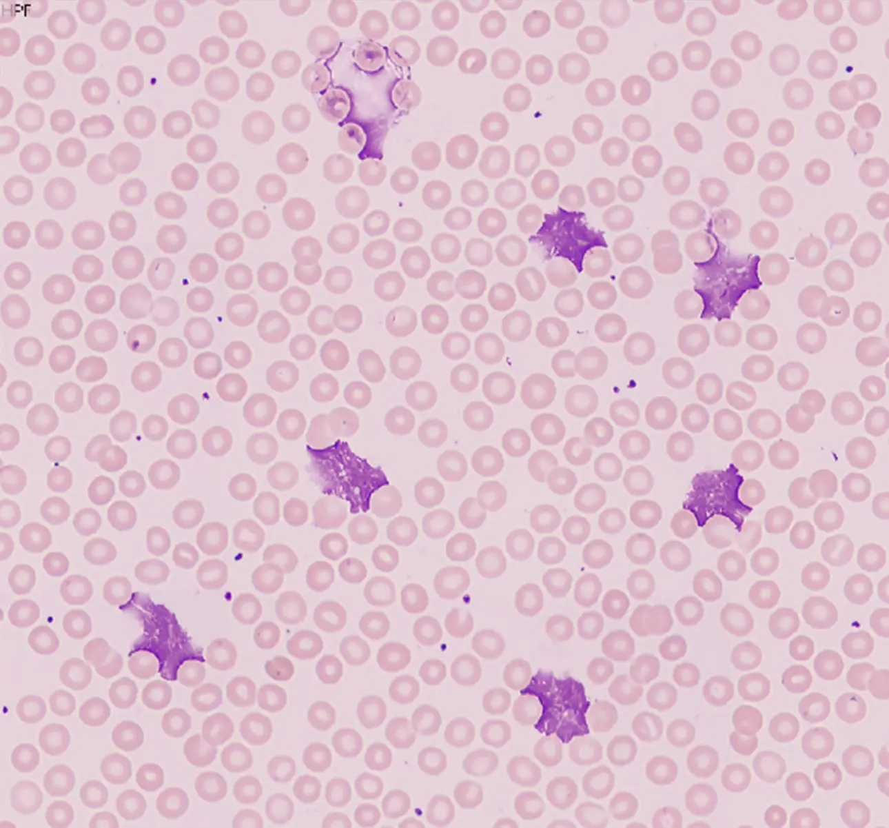 chronic-lymphocytic-leukemia-case-study-fig5