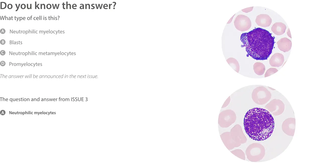 chronic-lymphocytic-leukemia-case-study-fig6-pc