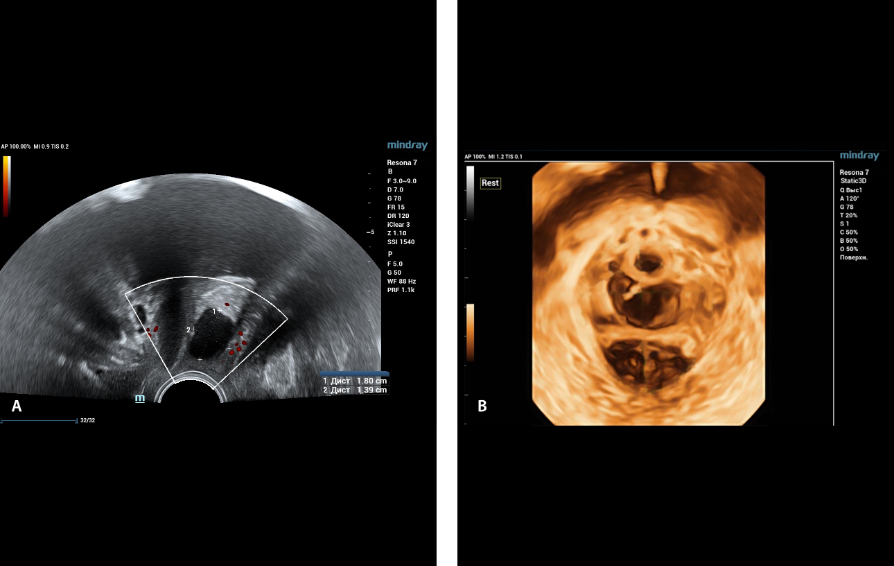 endometrioid-cyst-kv-pc