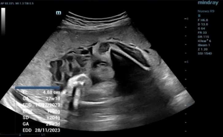 Fetal Biometric Measurements: Femur Length (FL) 