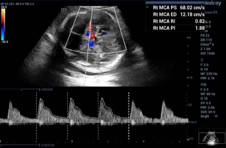 the second measurement of the doppler waveform of MCA in fetus with and the MCA-PSV value was 68.02 cm/s, which is greater than 1.55 MoM