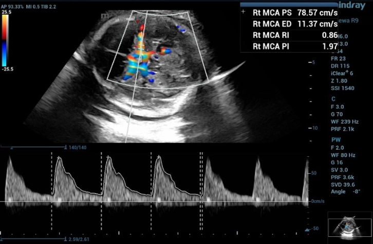 the third measurement of the doppler waveform of MCA in fetus with and the MCA-PSV value was 78.57 cm/s, which is greater than 1.55 MoM