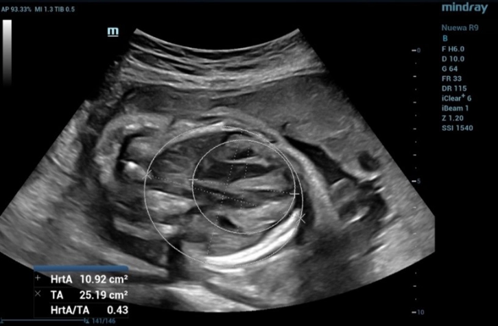 the measurement of the CTR in fetus and the CTR value was 0.43 