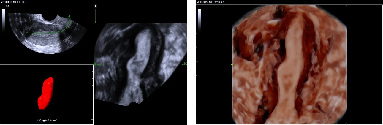 Use of Smart ERA in diagnosis of Mullerian duct abnormalities - Uni-cornuate uterus