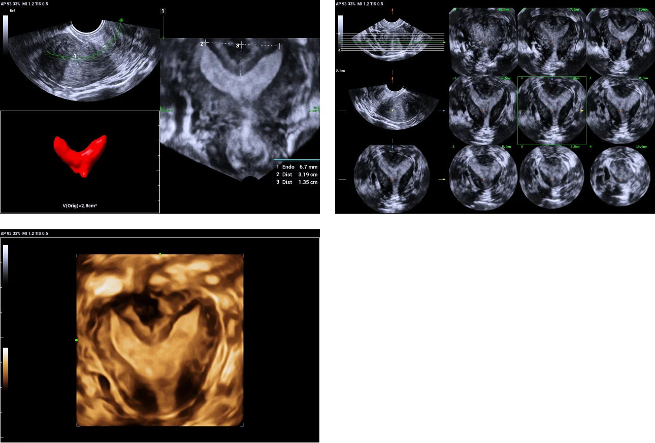 Use of Smart ERA in diagnosis of Mullerian duct abnormalities - Subseptate uterus