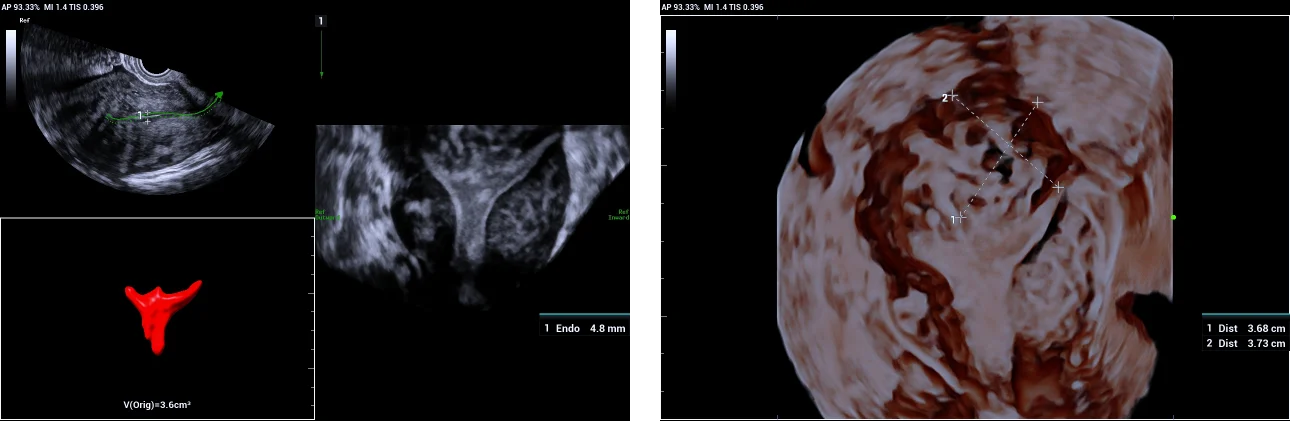 Use of Smart ERA in diagnosis of Mullerian duct abnormalities - Sub-mucosal fibroid indenting the fundal endometrium