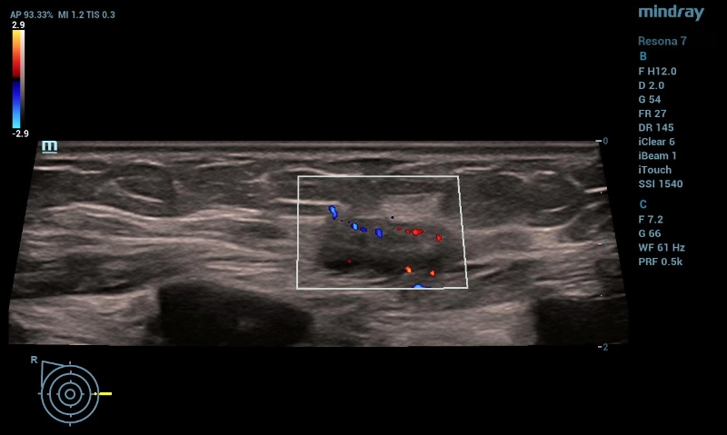 multiparametric-breast-mass-fig5