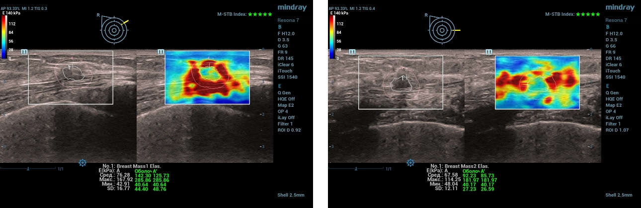 multiparametric-breast-mass-fig6-pc