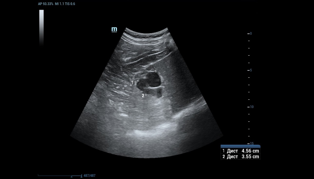 complex-cystic-renal-mass-fig1-pc