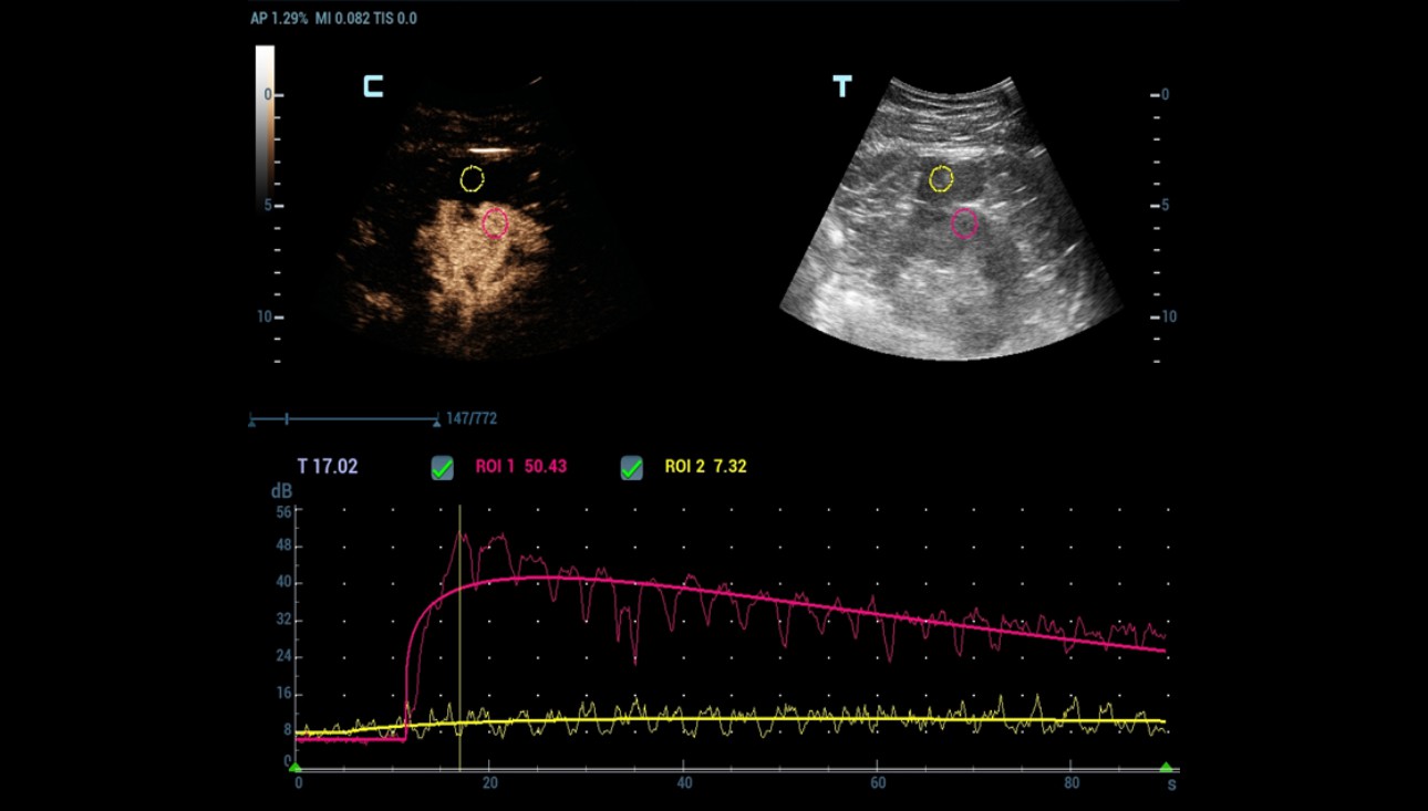 complex-cystic-renal-mass-fig6-pc