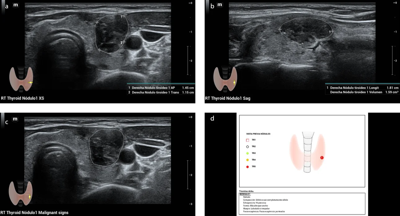 Fig. 2. Evaluation of thyroid nodule by artificial intelligence program Smart Thyroid, shows nodule in the middle third of the left thyroid lobe, solid, hypoechoic, wider than high, lobed or irregular edges and pointed echogenic foci, measures approximately 1.1 x 1.4 x 1.8 cm (a,b), evaluated as ACR TI-RADS 5.8(c ,d)