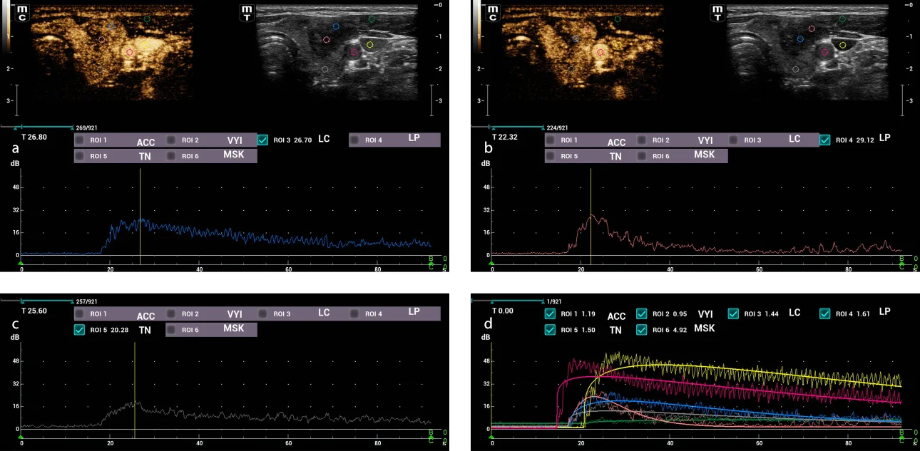 Fig.4. Enhacement curves analysis . In the upper images different ROIs were placed in the central and peripheral region of the thyroid nodule, as well as in the common carotid artery, internal jugular vein, thyroid parenchyma and adjacent musculature.