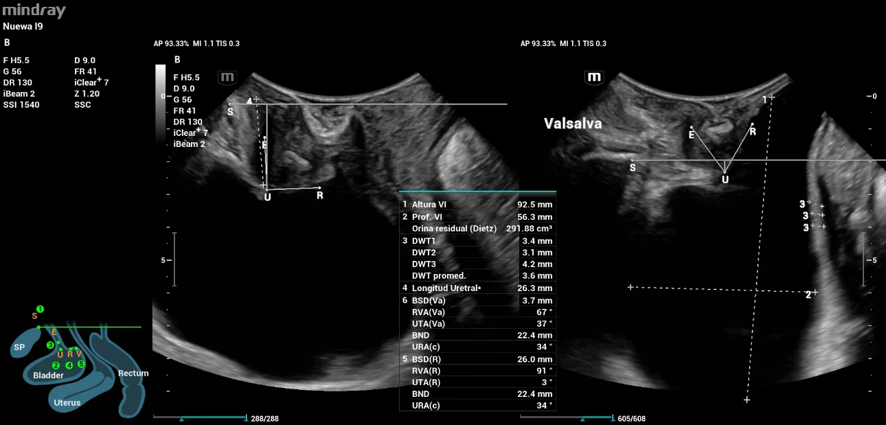 pelvic-floor-ultrasound-stress-incontinence-fig1