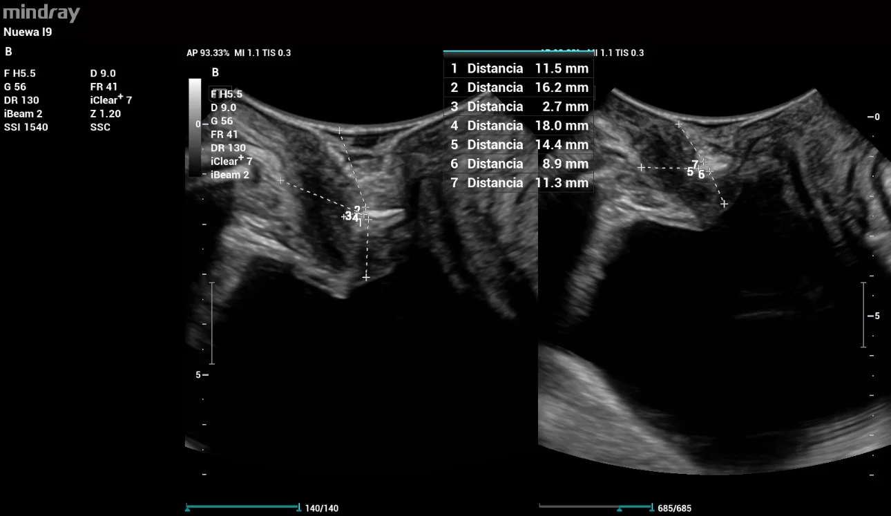 pelvic-floor-ultrasound-stress-incontinence-fig2