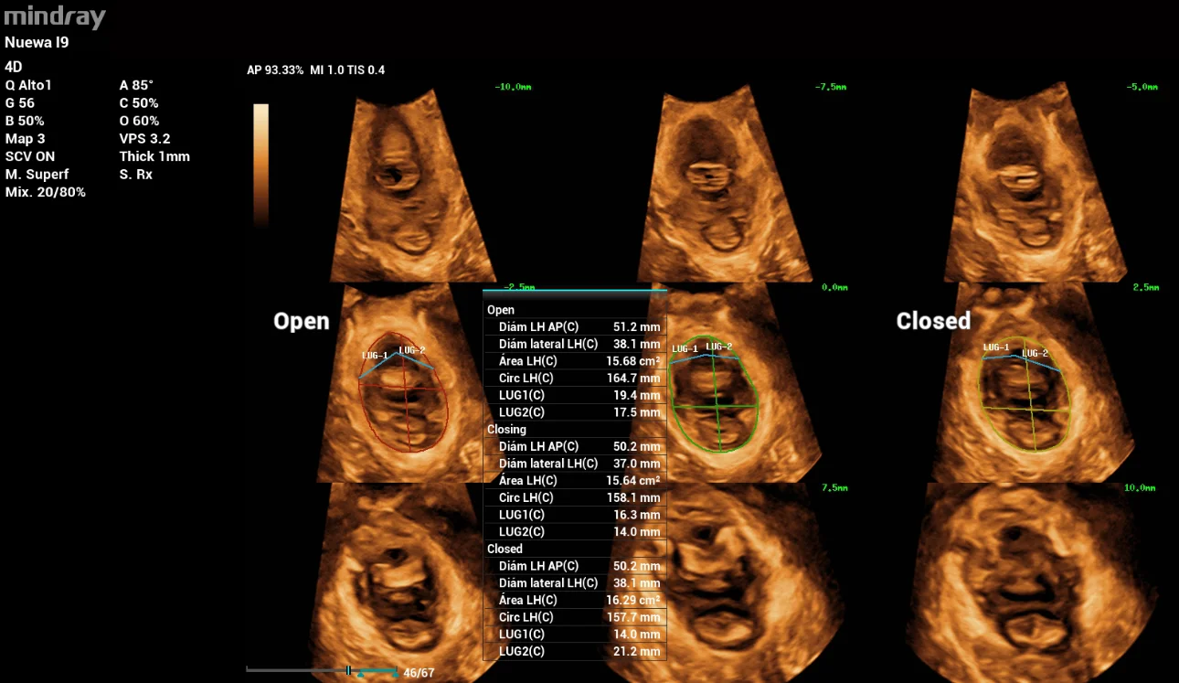 pelvic-floor-ultrasound-stress-incontinence-fig4