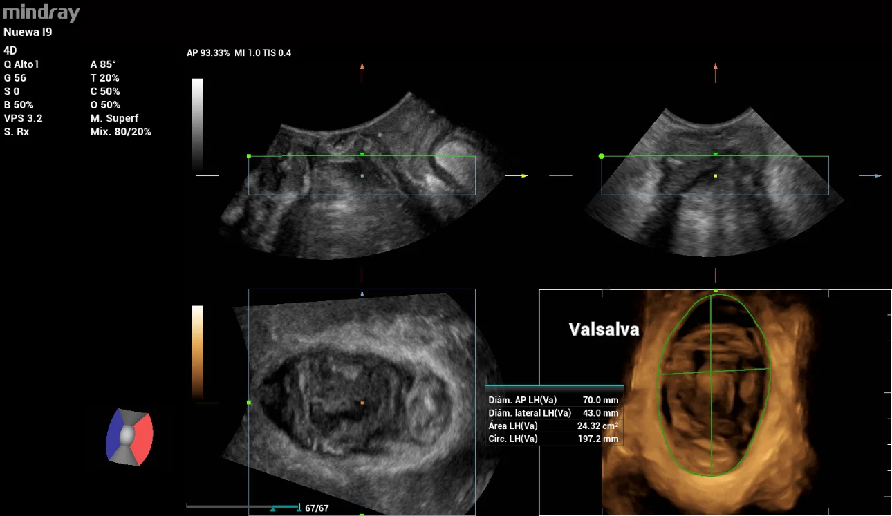 pelvic-floor-ultrasound-stress-incontinence-fig5