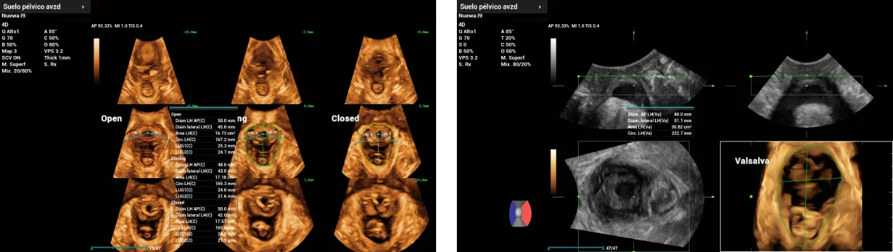 pelvic-floor-ultrasound-stress-incontinence-fig9