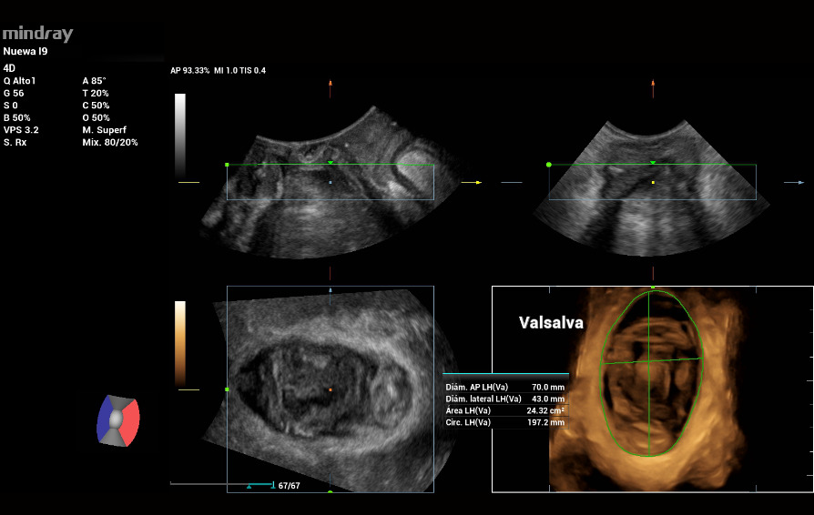 pelvic-floor-ultrasound-stress-incontinence-kv-pc