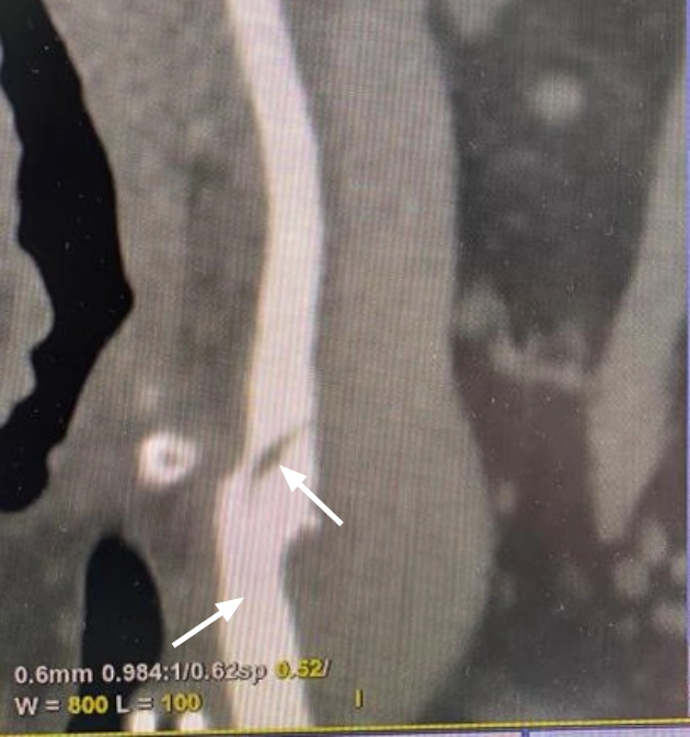 cardiovascular-pathology-fig8