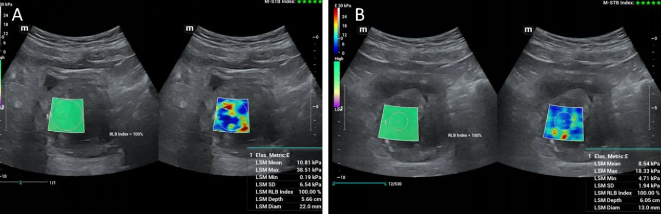 prostatic-artery-embolization-fig3-pc