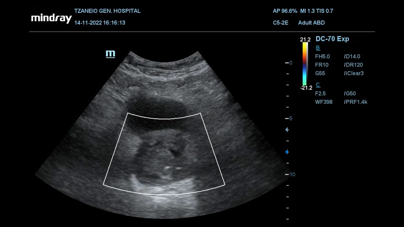 prostatic-artery-embolization-video-pc