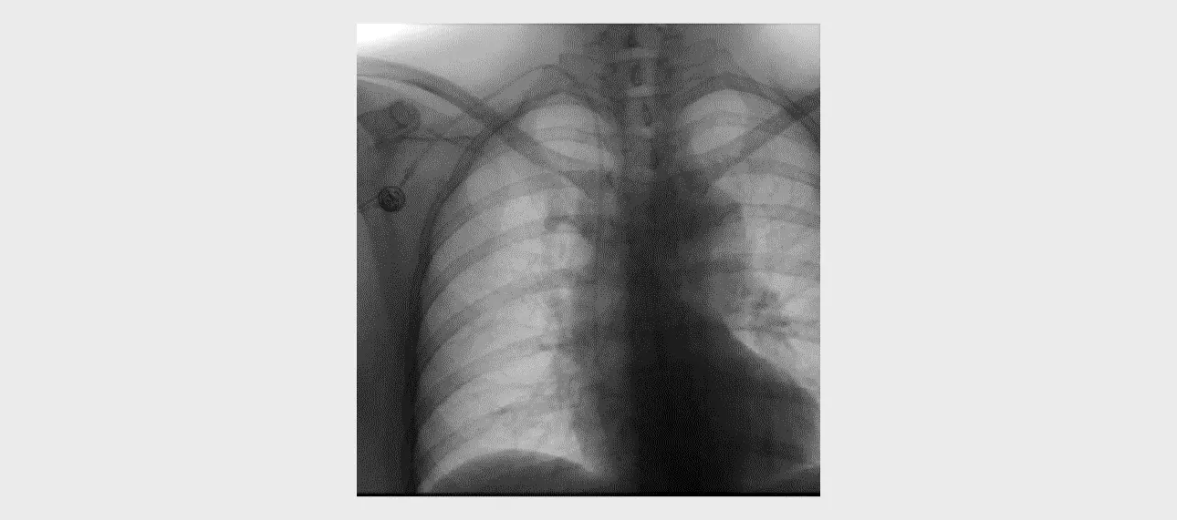 subcutaneous-venous-port-fig4-pc