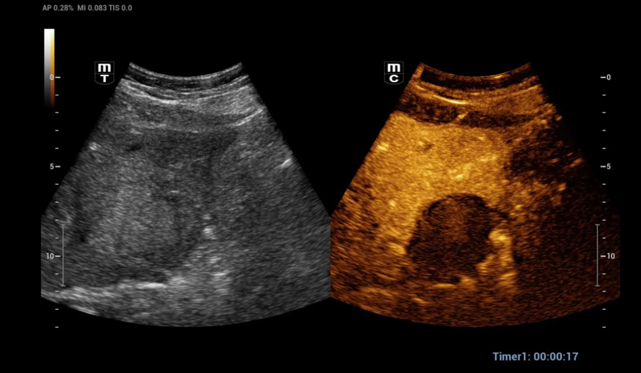 thermal-ablation-fig2-pc