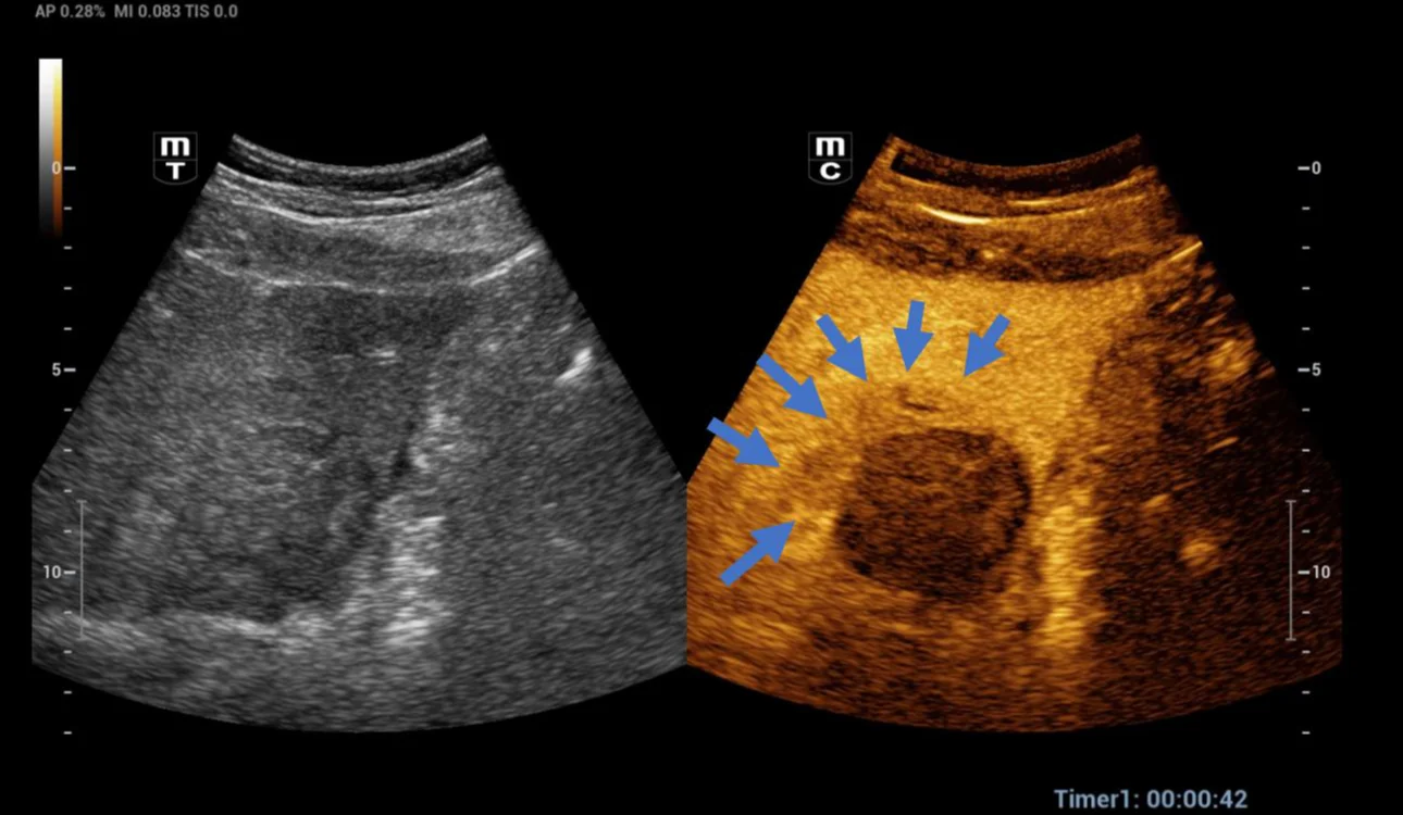 thermal-ablation-fig3-pc