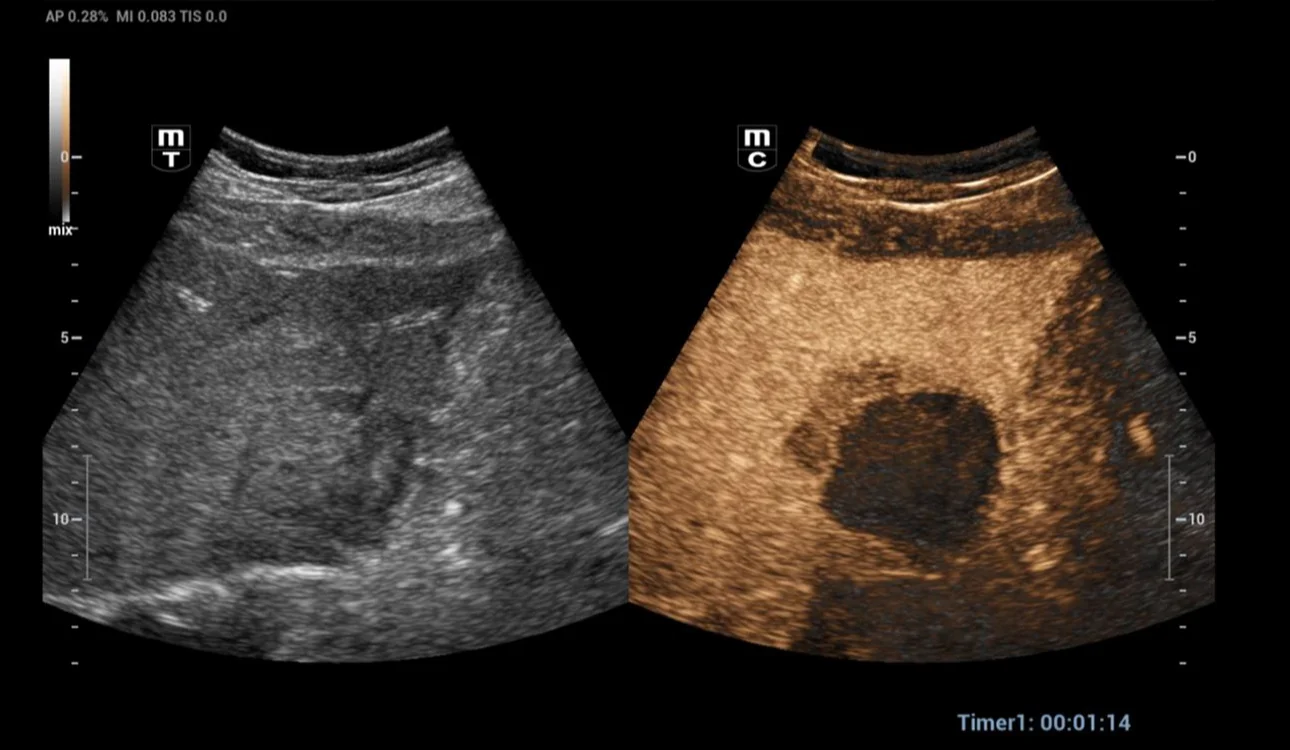 thermal-ablation-fig4-pc