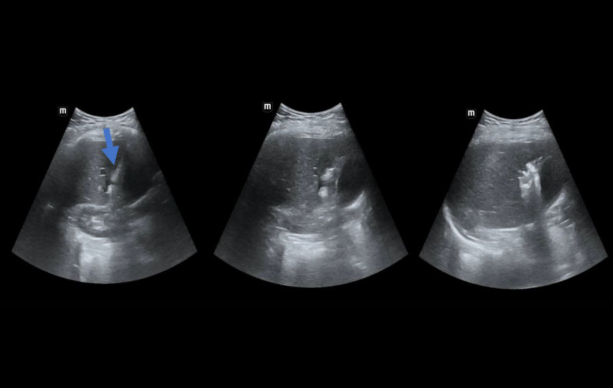 thermal-ablation-kv-pc