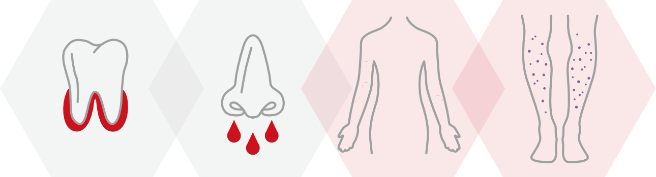 thrombocytopenia-smear-fig1-pc