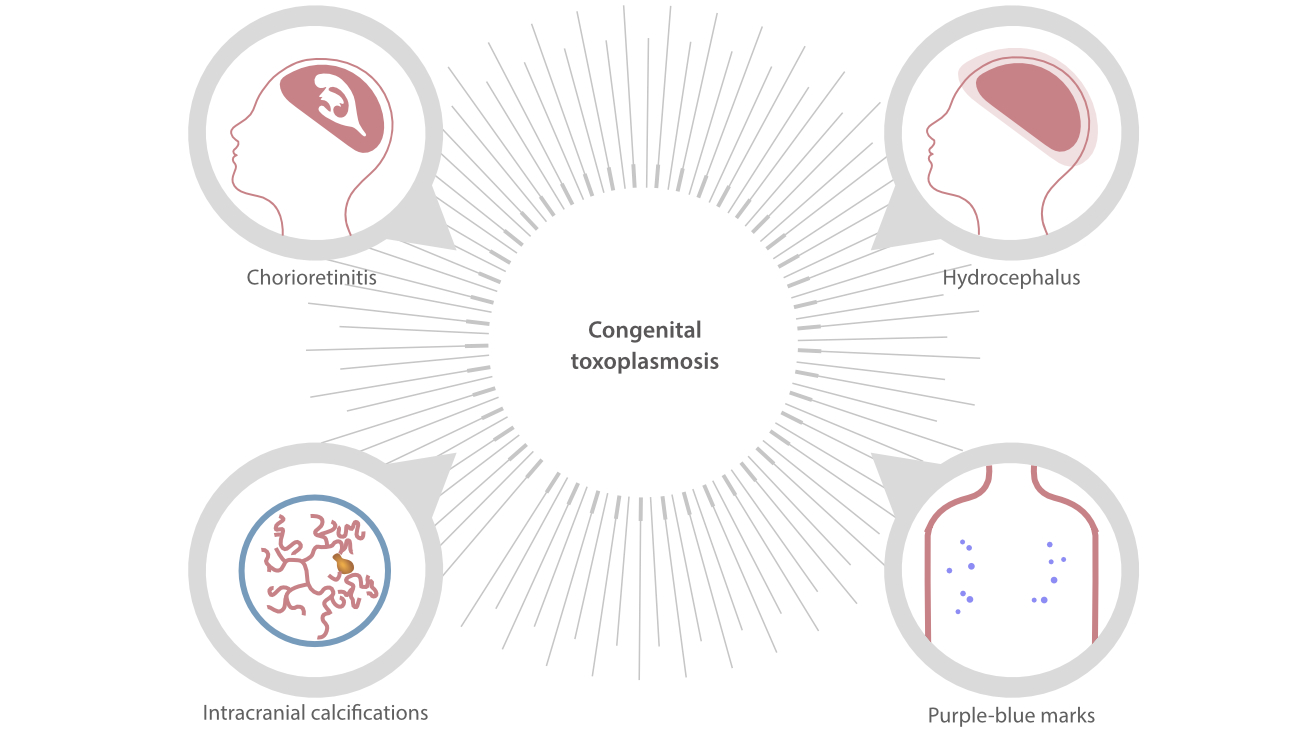 Toxoplasmosis-fig3-pc