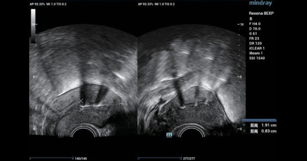 intrauterine-device-fig5-pc