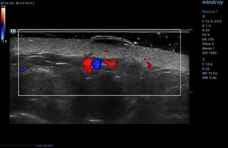 Ultrasound examination of the nevus in Color Doppler mode