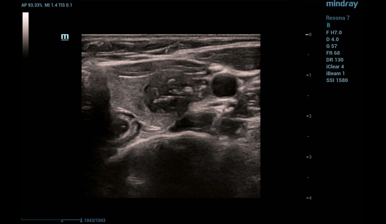 throid-sclerotherapy-fig8-pc