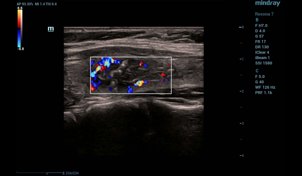 throid-sclerotherapy-fig9-pc