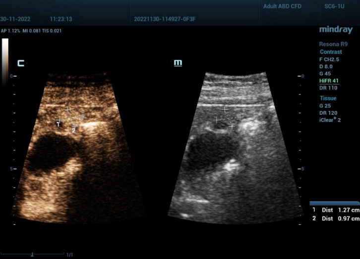 diagnoses-hifr-ceus-fig2