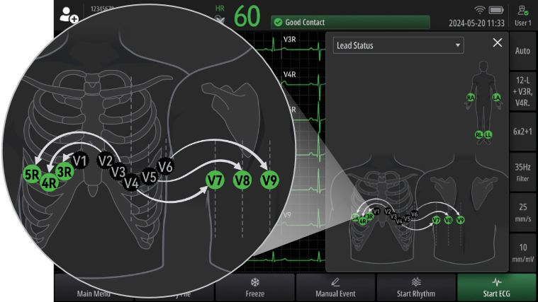 BeneHeart R700/R900 Electrocardiograph - Additional Leads Guidance