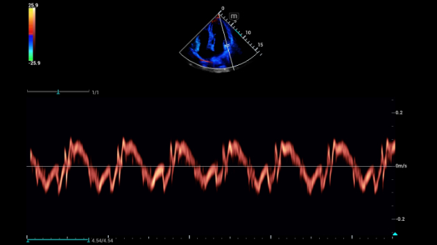 Consona Series Cardiovascular Solution - TDI feature clinical image