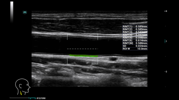 Consona Series Cardiovascular Solution - RIMT feature clinical image