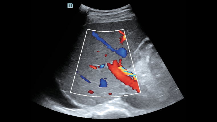 hepatus-series-fig10-3-pc