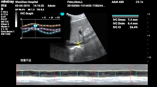 Smart IVC