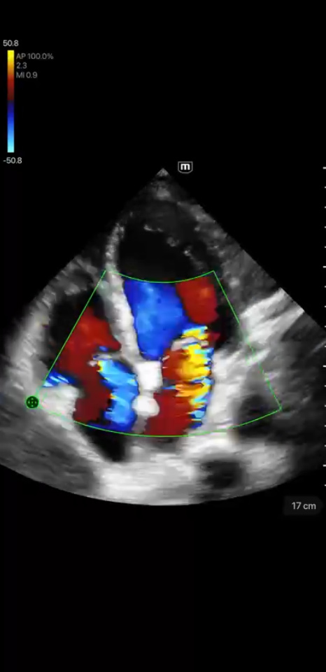 Regurgitación mitral y tricúspide